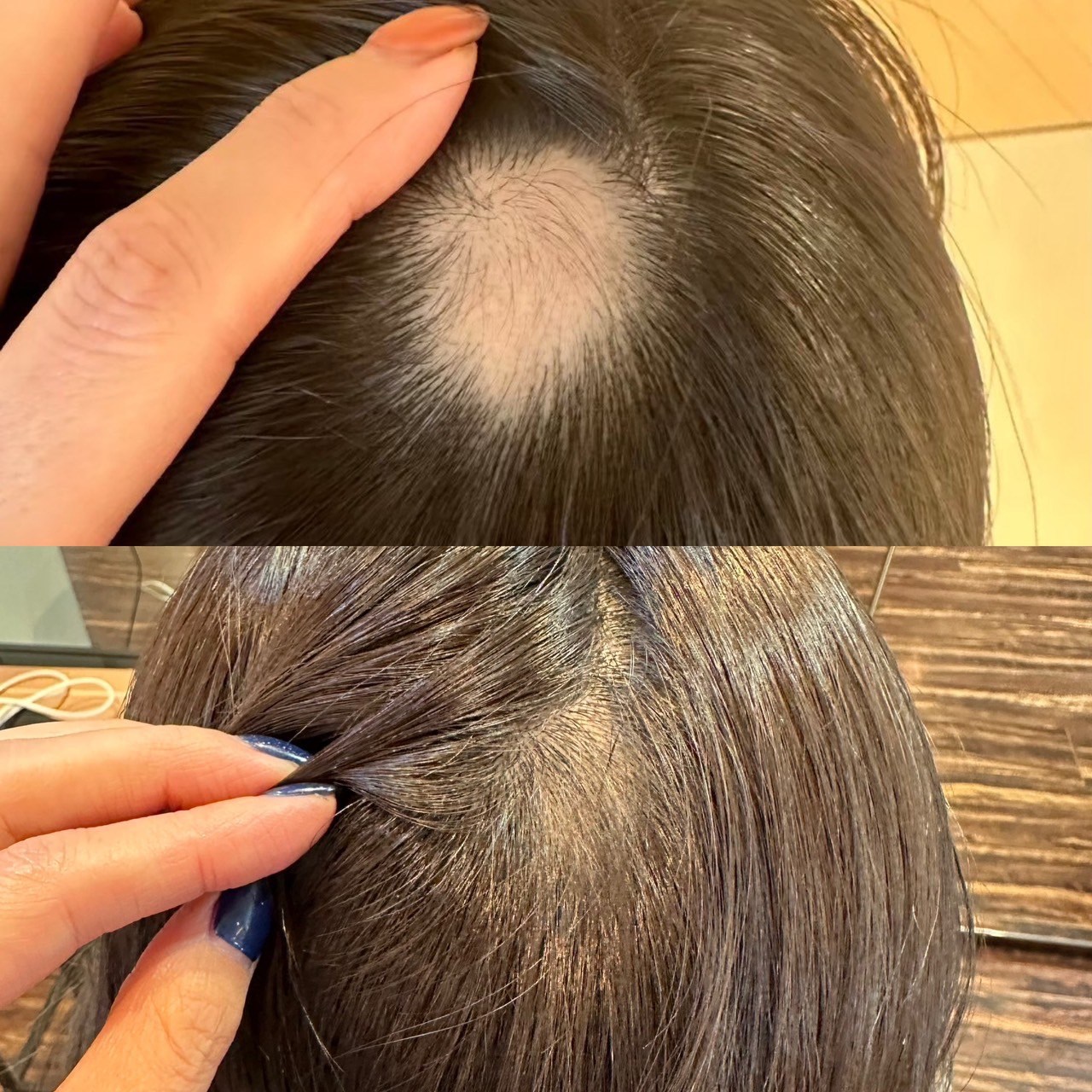 薄毛・つむじのビフォーアフター